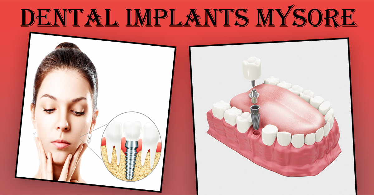 Best Dental Implants in Mysore | Best Implantologist