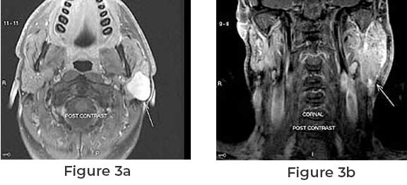 Symptoms of Facial Nerve Cancer and Treatment Procedure – alphasurg