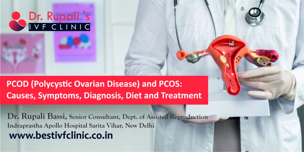 PCOD (Polycystic Ovarian Disease) and PCOS: Causes, Symptoms, Diagnosis, Diet and Treatment - Best IVF clinic