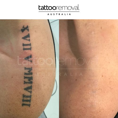 Top Mistakes to Avoid When Starting a Tattoo Removal Business: tattooremoval08 — LiveJournal