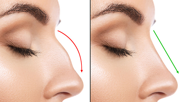 Nose Reshaping | Non Surgical Rhinoplasty in London