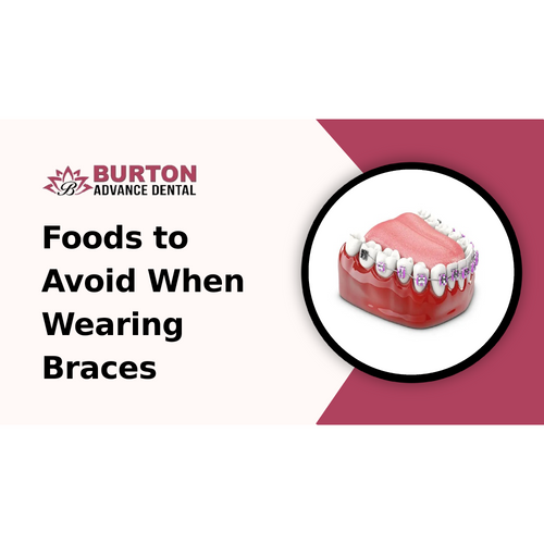 Foods to Avoid When Wearing Braces