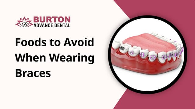 Foods to Avoid When Wearing Braces