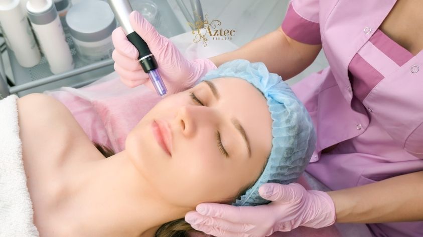 Microneedling Treatment in San Diego | Aztec Tan San Diego
