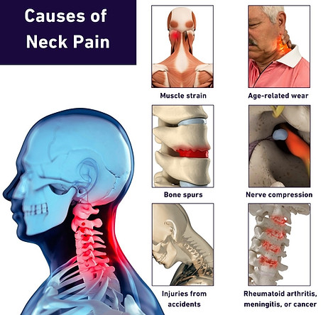 Neck Pain Newport Beach