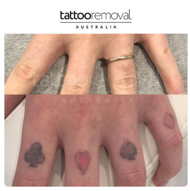 Does Laser Tattoo Removal Hurt? What to Expect?: tattooremoval08 — LiveJournal